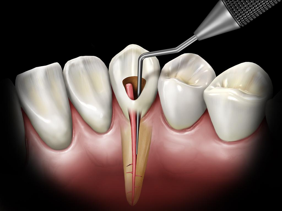 Dental Root Canal Treatment Will Prolong The Life Of Your Tooth!