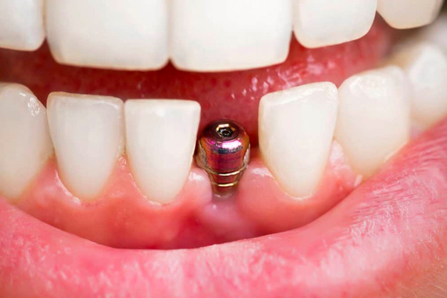 Do Dental Implants Compare to Your Natural Teeth in Strength?