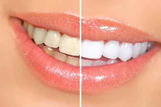 Teeth Whitening Post Care Is Important To Maintain Your Smile Keep Looking Its Best