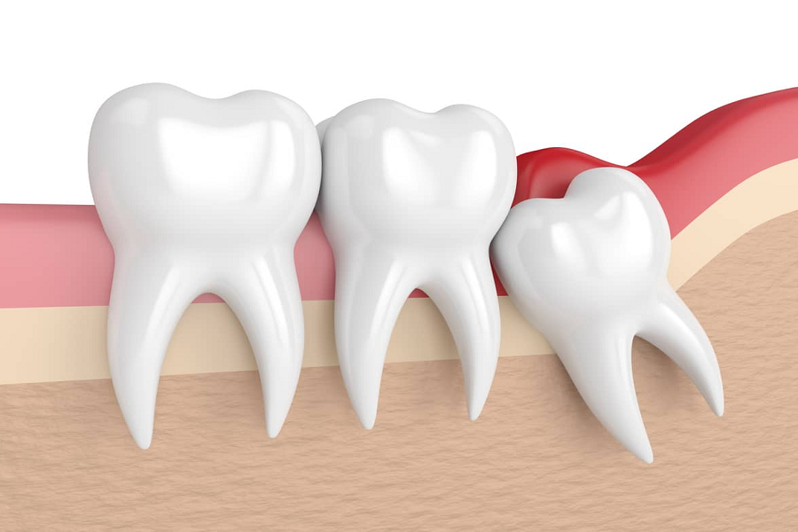 Impacted Wisdom Tooth: Is Removal Necessary?