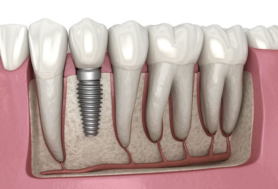 Dental Implant, A Practical Substitute for Dentures to Replace Missing Teeth?