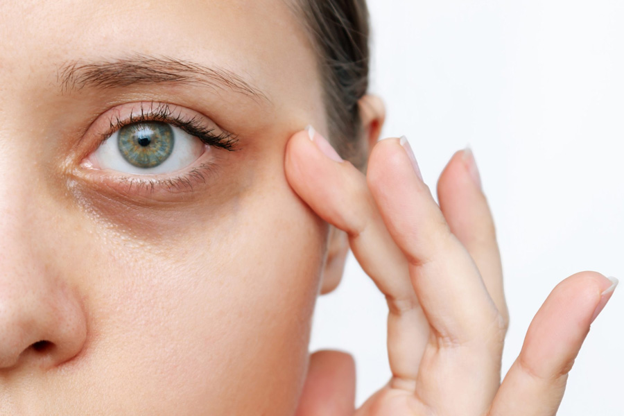 Dark Circles and Under Eye Bags