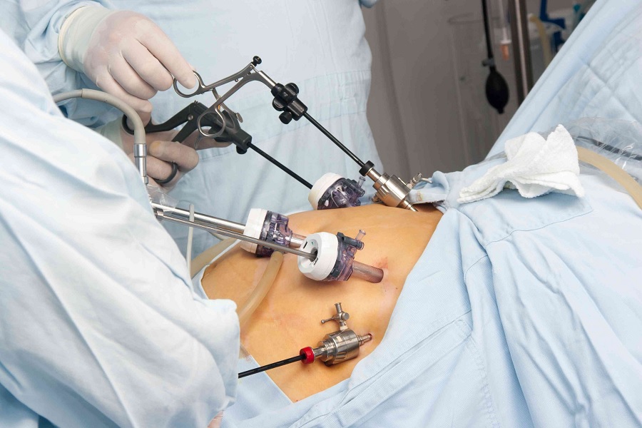What is a Bariatric Surgery and How it Works?