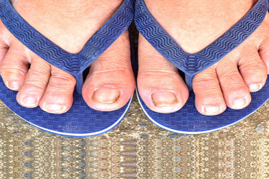 Be Aware of the Treatment of Toenail Fungus in Your Child