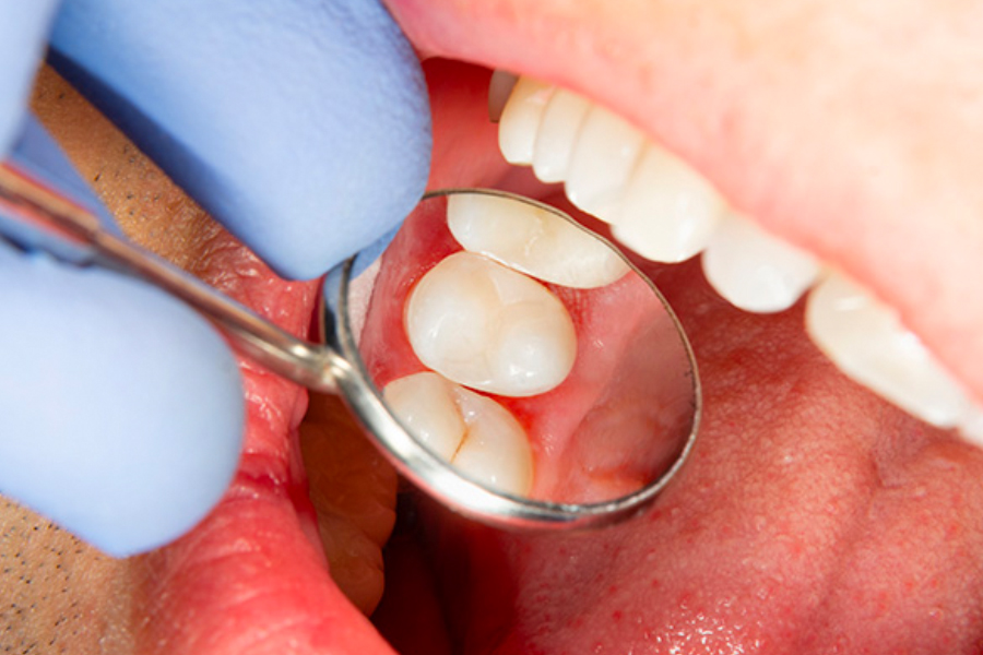 When Are You Recommended to Have Root Canal Therapy?