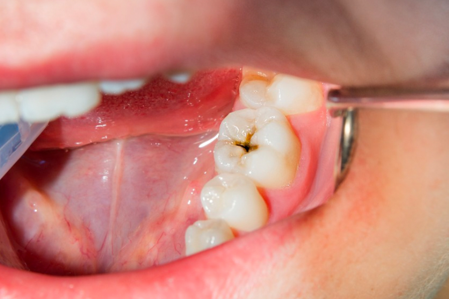 Fluoride Can Help Your Teeth From The Cavity And Make Them Stronger