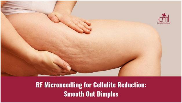 RF Microneedling for Cellulite Reduction: Smooth Out Dimples