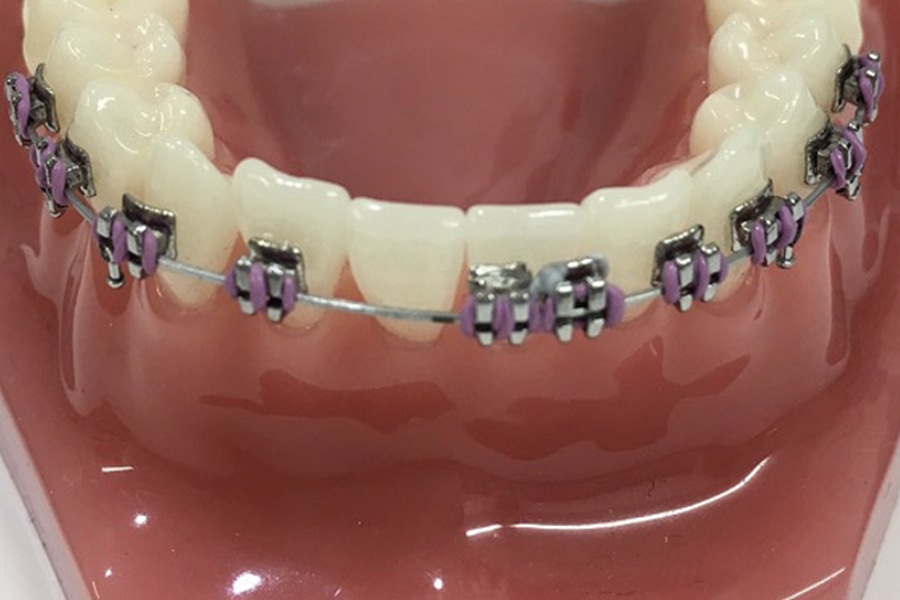 What Leads Orthodontic Brackets to Break?