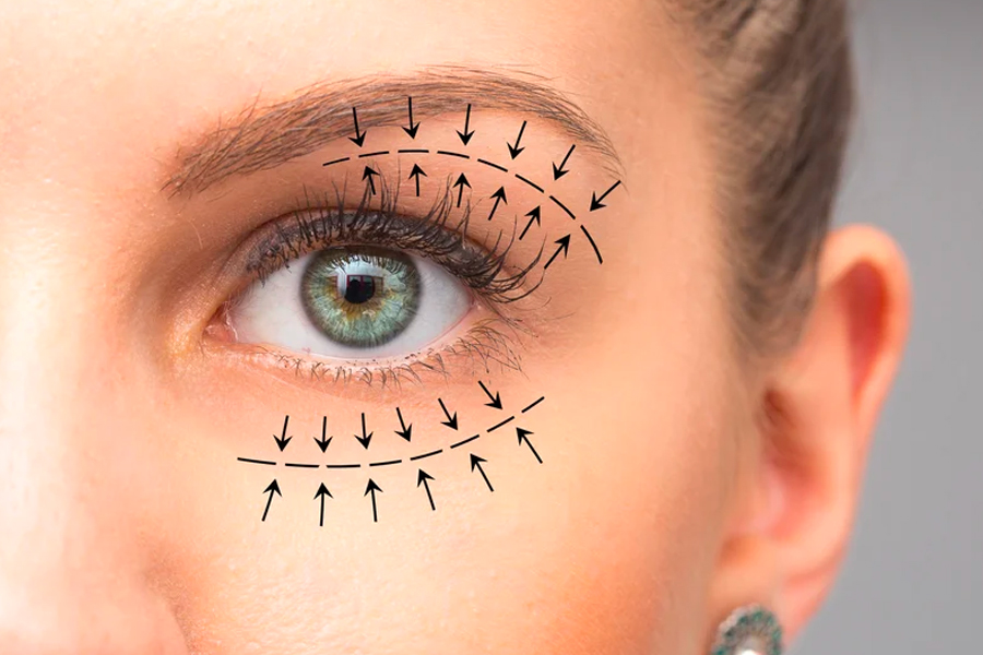4 Conditions You Must Go Through Droopy Eyelid Lift Surgery