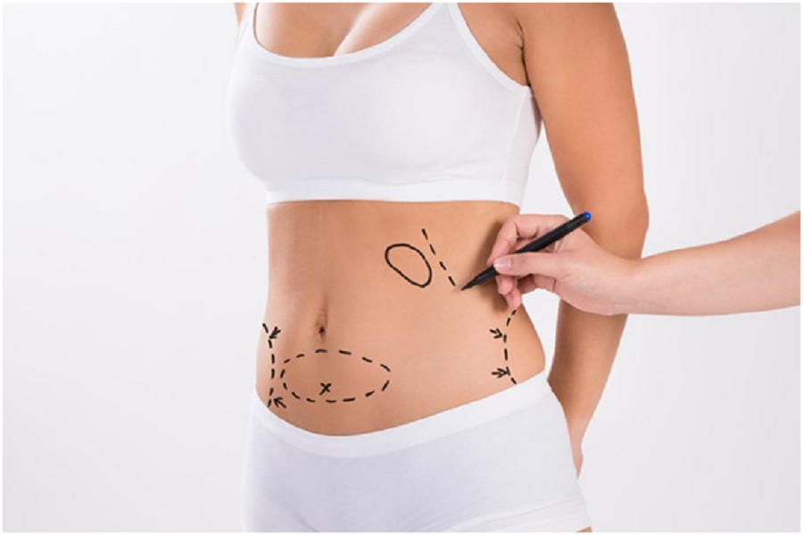 Is Liposuction The Best Procedure For You?