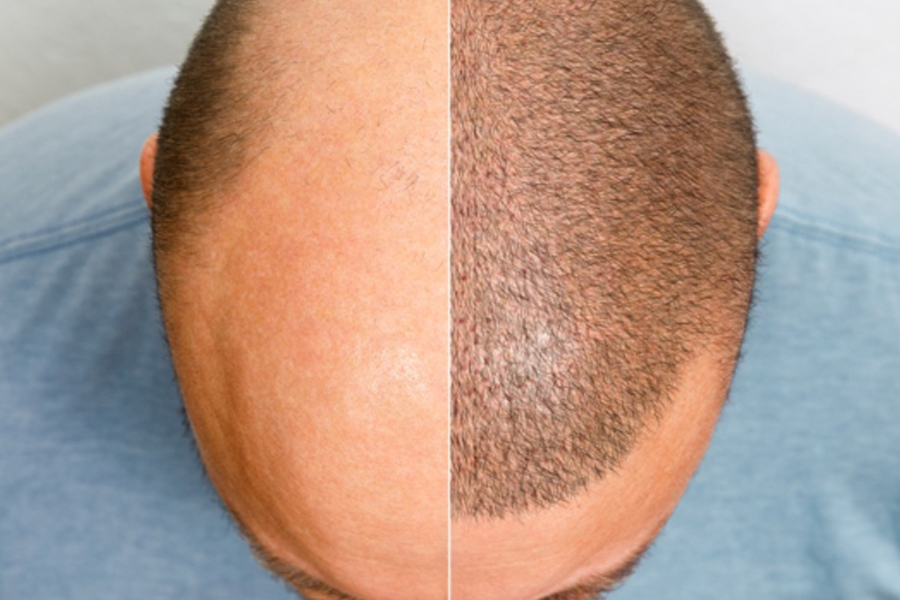 How To Take Care Of The Donor Area After Hair Transplant?
