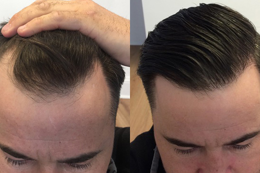 A Complete Guide To Everything You Should Know About Hair Transplants